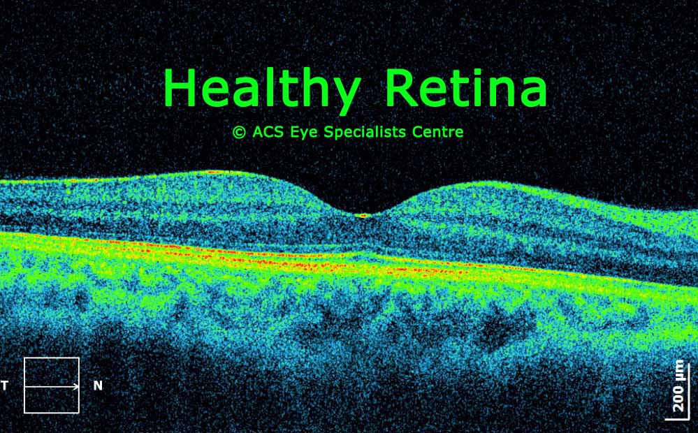 OCT scan healthy Retina